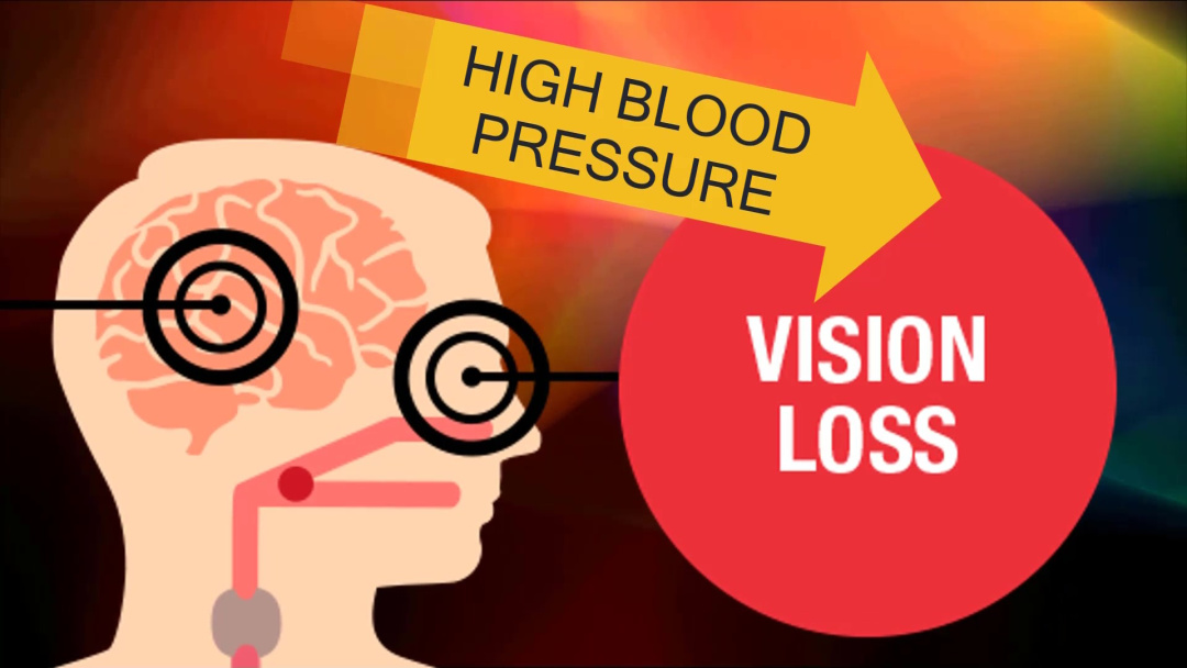 Can High Blood Pressure Cause Glaucoma and Macular Degeneration?
